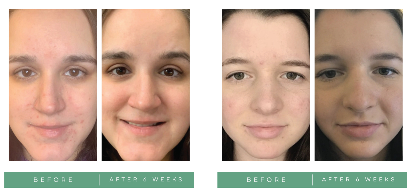 Replenix BP Acne Face Wash